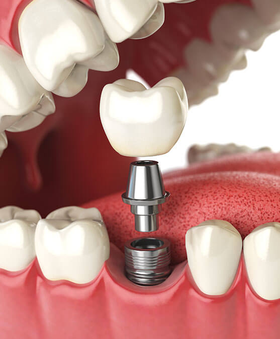 illustration of a dental implant