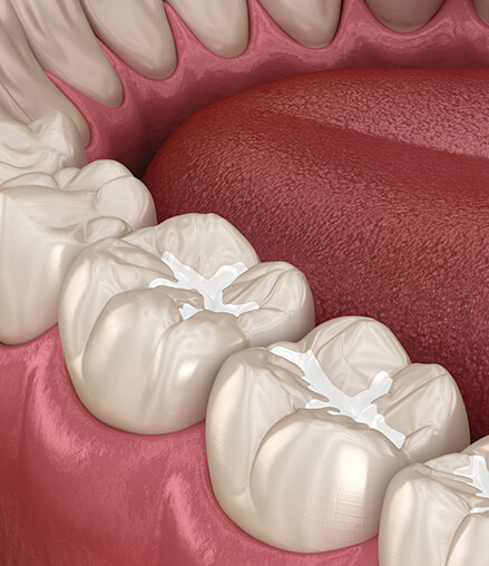 illustration of a dental filling