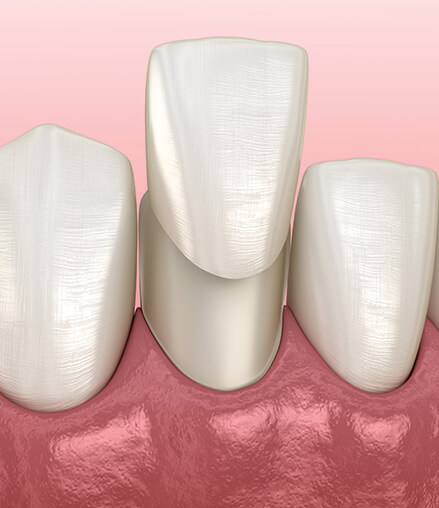 illustration of a dental veneer