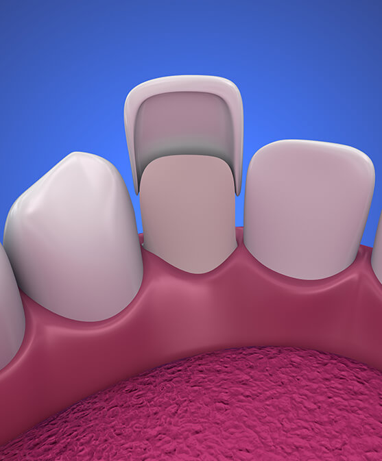 illustration of a dental veneer